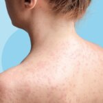 Can I Get Measles if I’m Vaccinated?