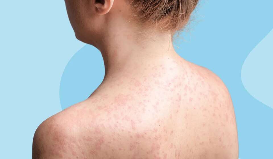 Can I Get Measles if I’m Vaccinated?